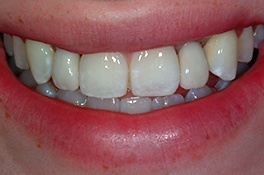 dentalimplantafter1 dentalimplantafter1
