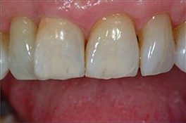 dentalimplantafter2 dentalimplantafter2