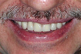 dentalimplantafter3 dentalimplantafter3