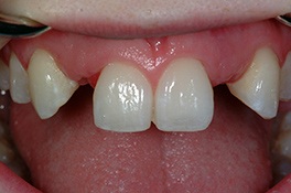 dentalimplantbefore1 dentalimplantbefore1