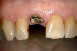 dentalimplantbefore2 dentalimplantbefore2