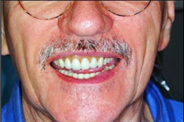dentalimplantbefore3 dentalimplantbefore3