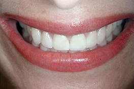 veneerafter1 veneerafter1