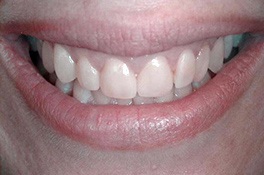 veneerbefore1 veneerbefore1
