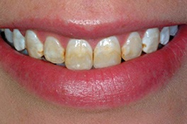veneerbefore2 veneerbefore2