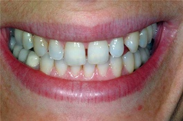 veneerbefore3 veneerbefore3